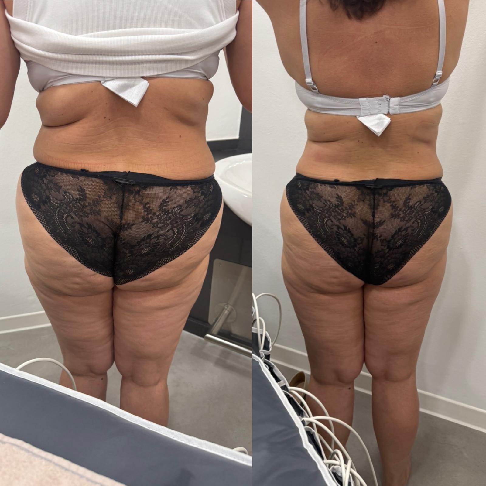 Bodyforming Vorher-Nachher-Eindruck bei Beauty Secrets in Wedel (Eine Behandlung)