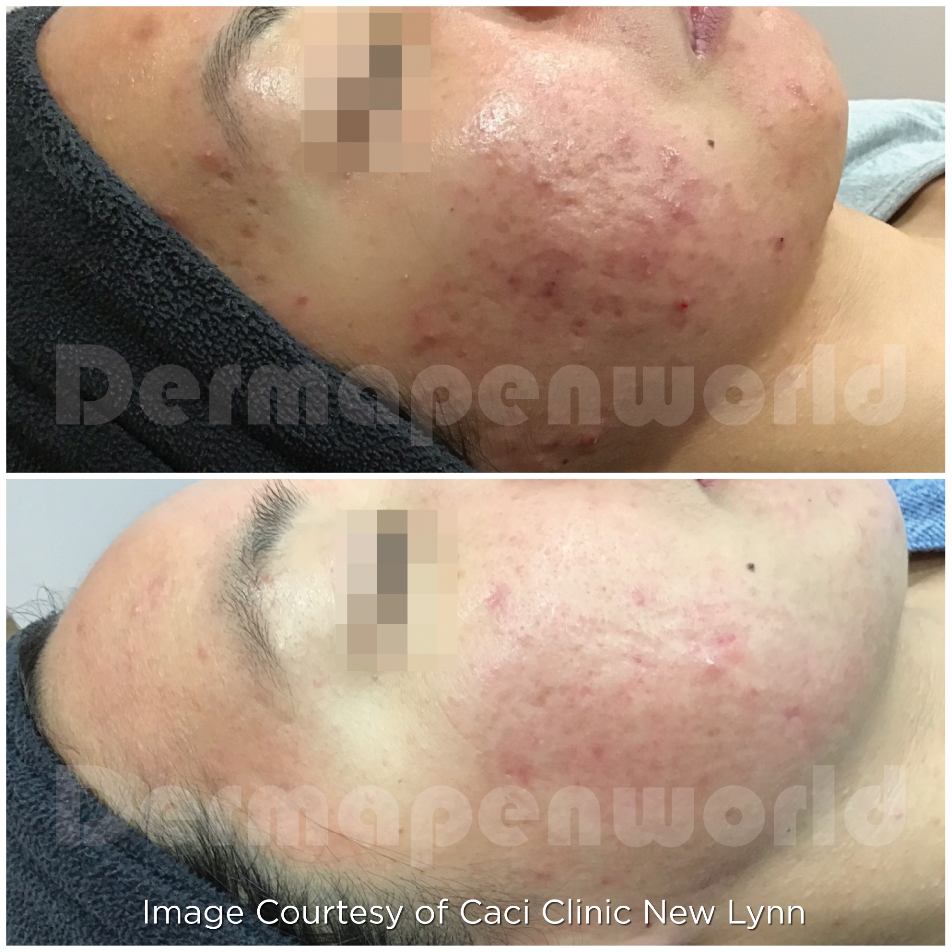 Dermapen 4 Vorher-Nachher-Ergebnis bei Beauty Secrets in Wedel – Aknenarben