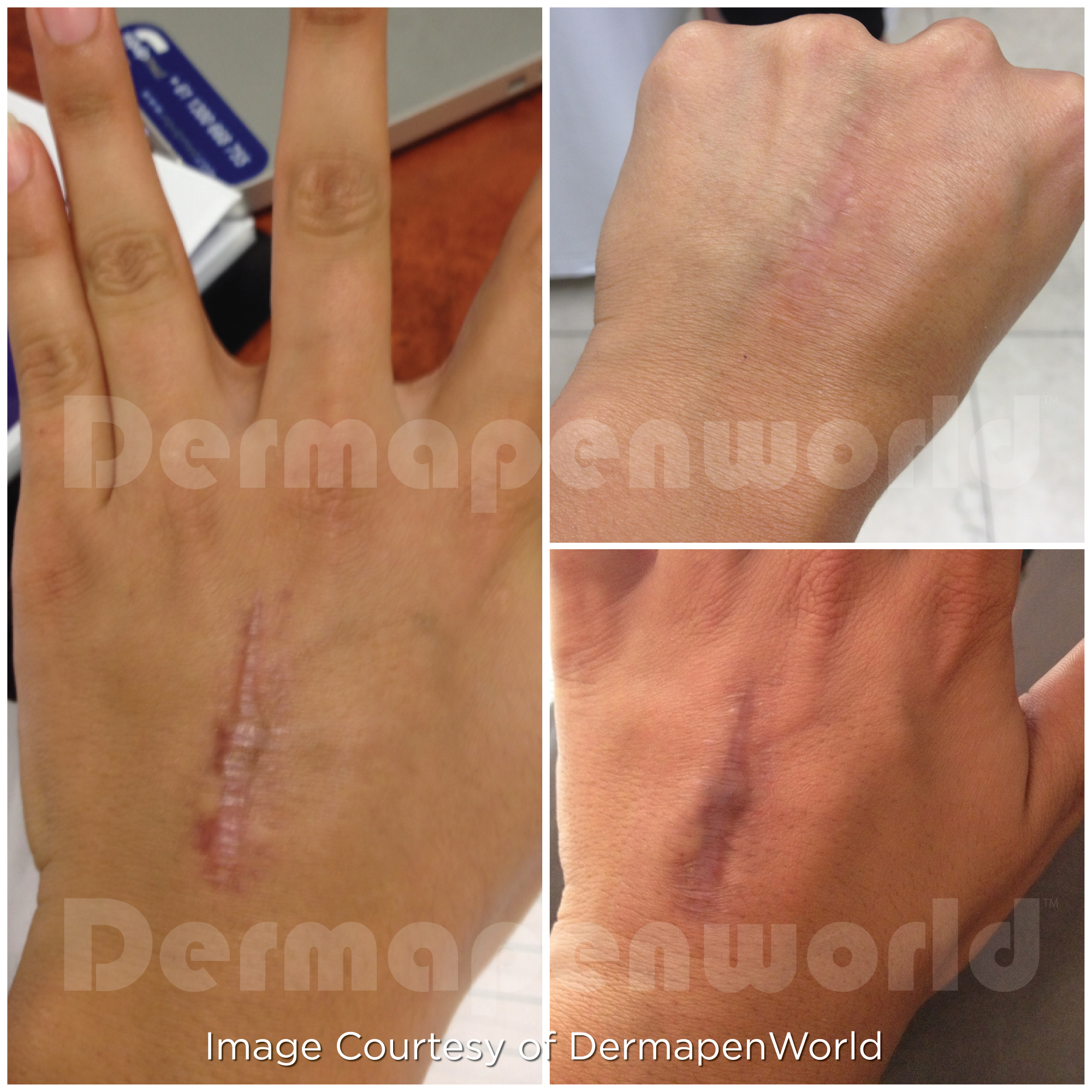 Dermapen 4 Vorher-Nachher-Ergebnis bei Beauty Secrets in Wedel – Operationsnarben