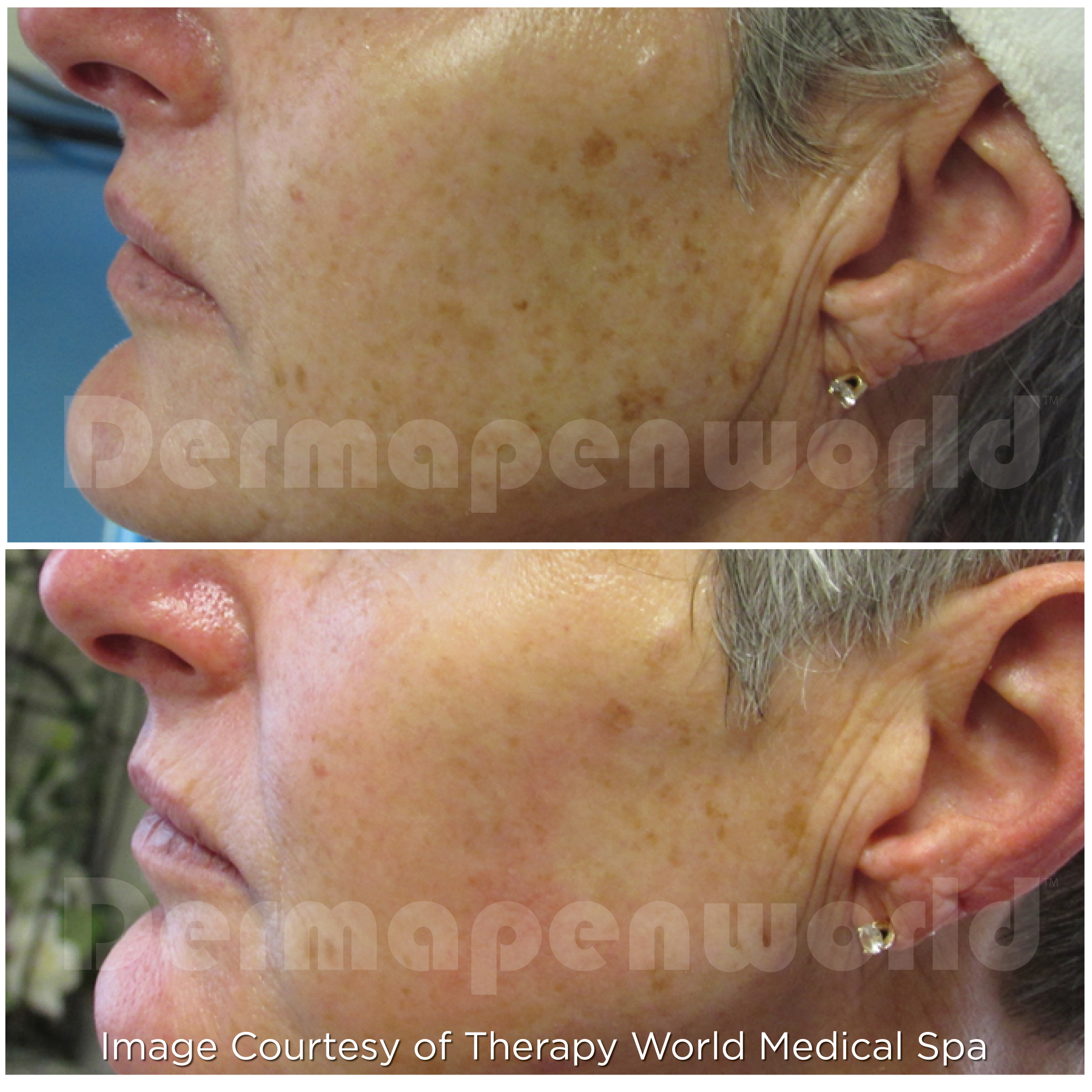 Dermapen 4 Vorher-Nachher-Ergebnis bei Beauty Secrets in Wedel – Pigmentflecken