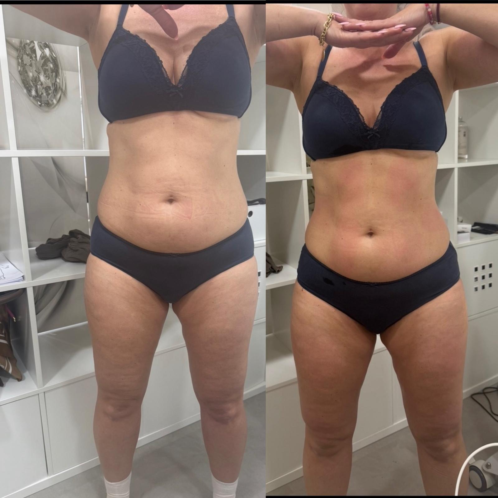 Bodyforming Vorher-Nachher-Eindruck bei Beauty Secrets in Wedel (Eine Behandlung)