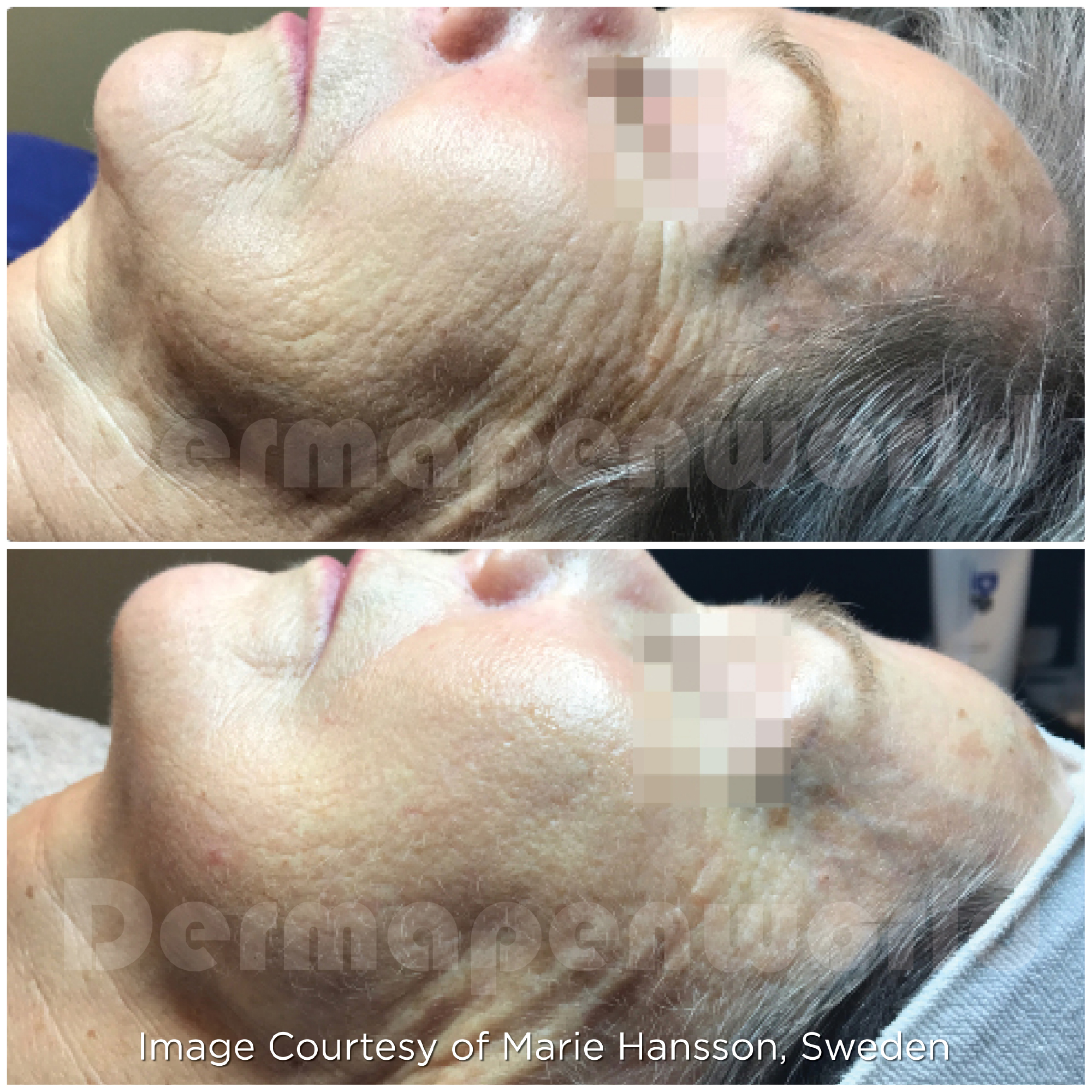 Dermapen 4 Vorher-Nachher-Ergebnis bei Beauty Secrets in Wedel – Hautverjüngung