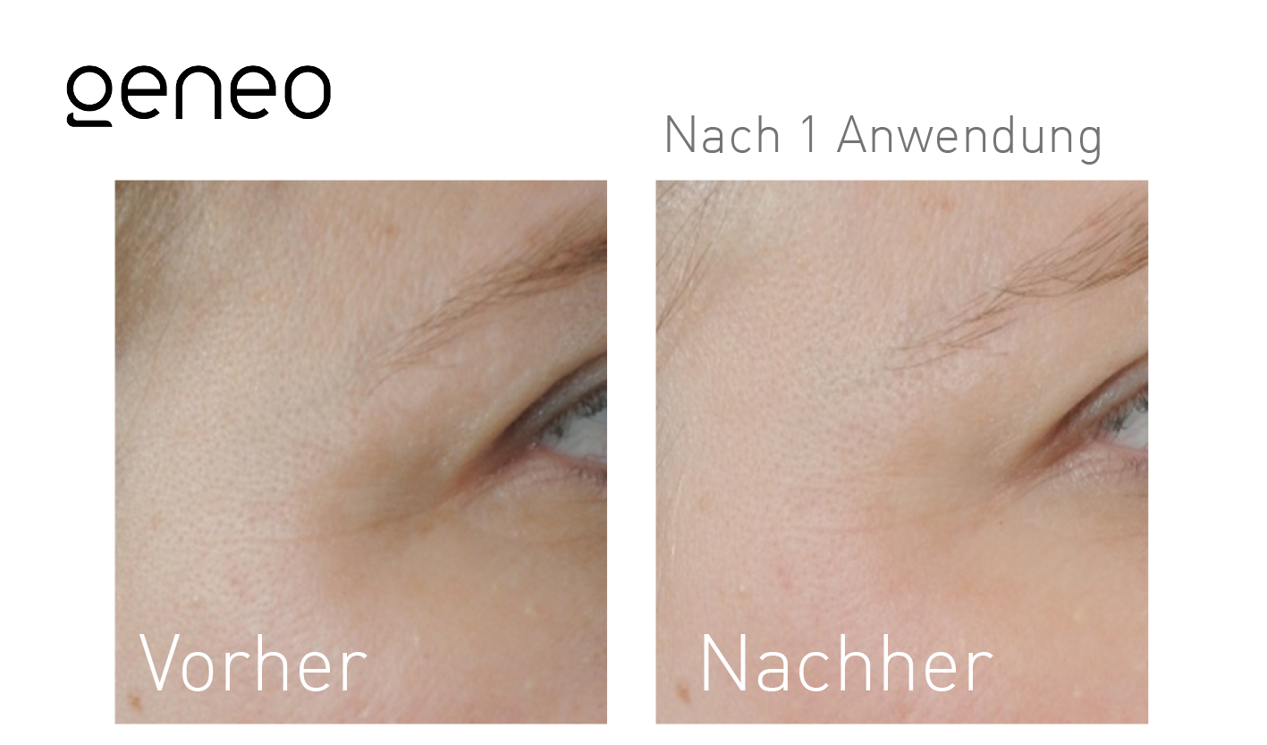 Geneo Vorher-Nachher-Ergebnis bei Beauty Secrets in Wedel – Nach 1 Behandlung