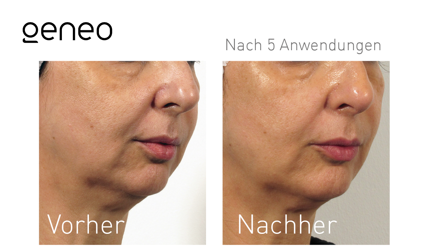 Geneo Vorher-Nachher-Ergebnis bei Beauty Secrets in Wedel – Nach 5 Behandlungen