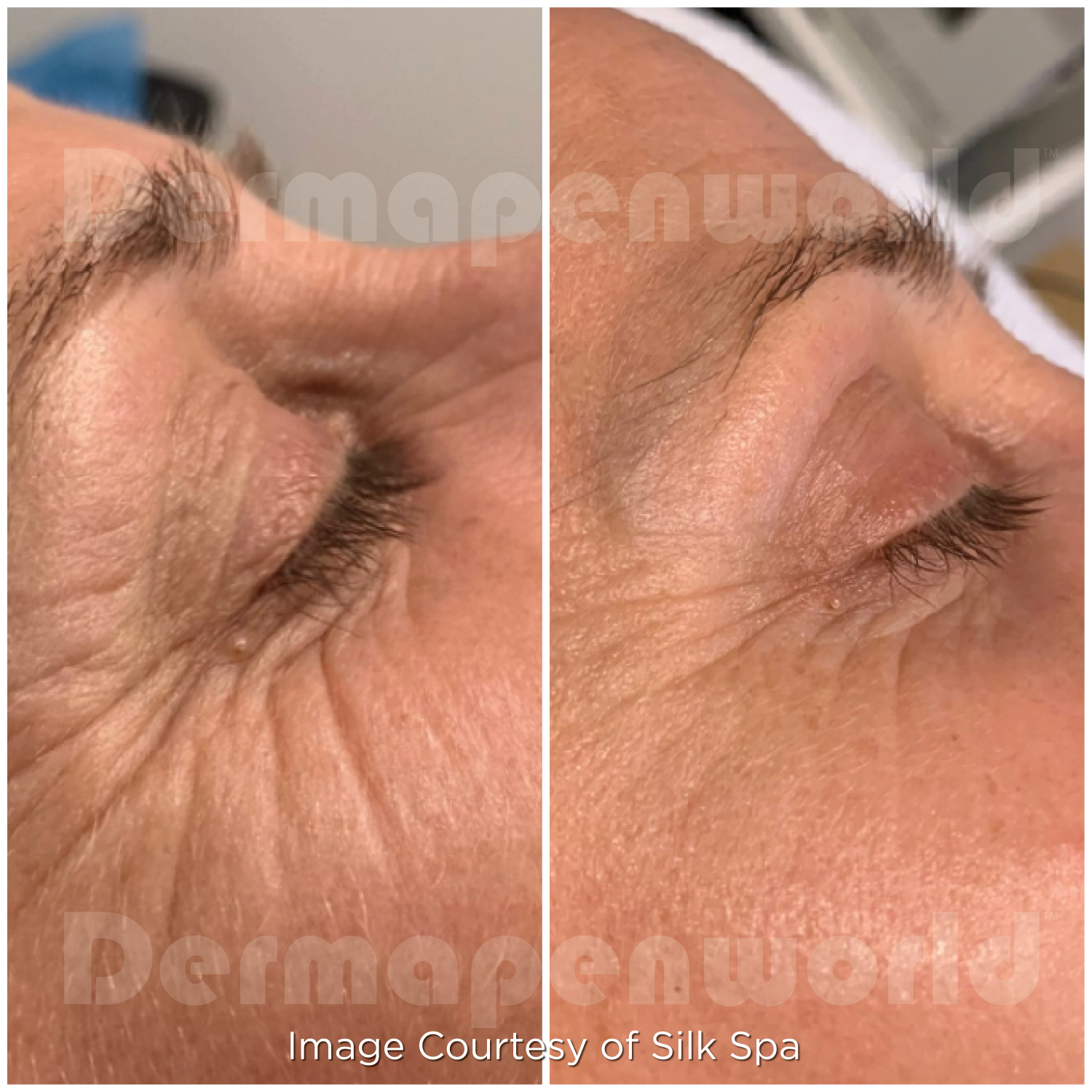 Dermapen 4 Vorher-Nachher-Ergebnis bei Beauty Secrets in Wedel – Fältchen & Hautalterung