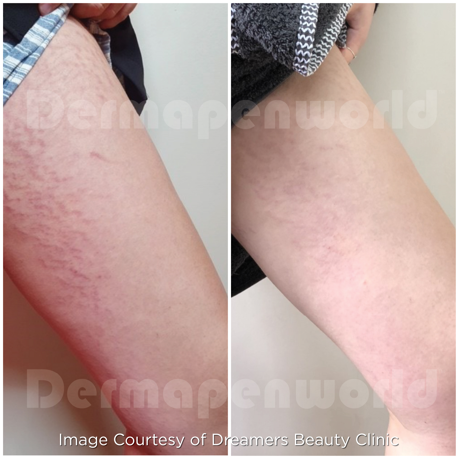 Dermapen 4 Vorher-Nachher-Ergebnis bei Beauty Secrets in Wedel – Dehnungsstreifen