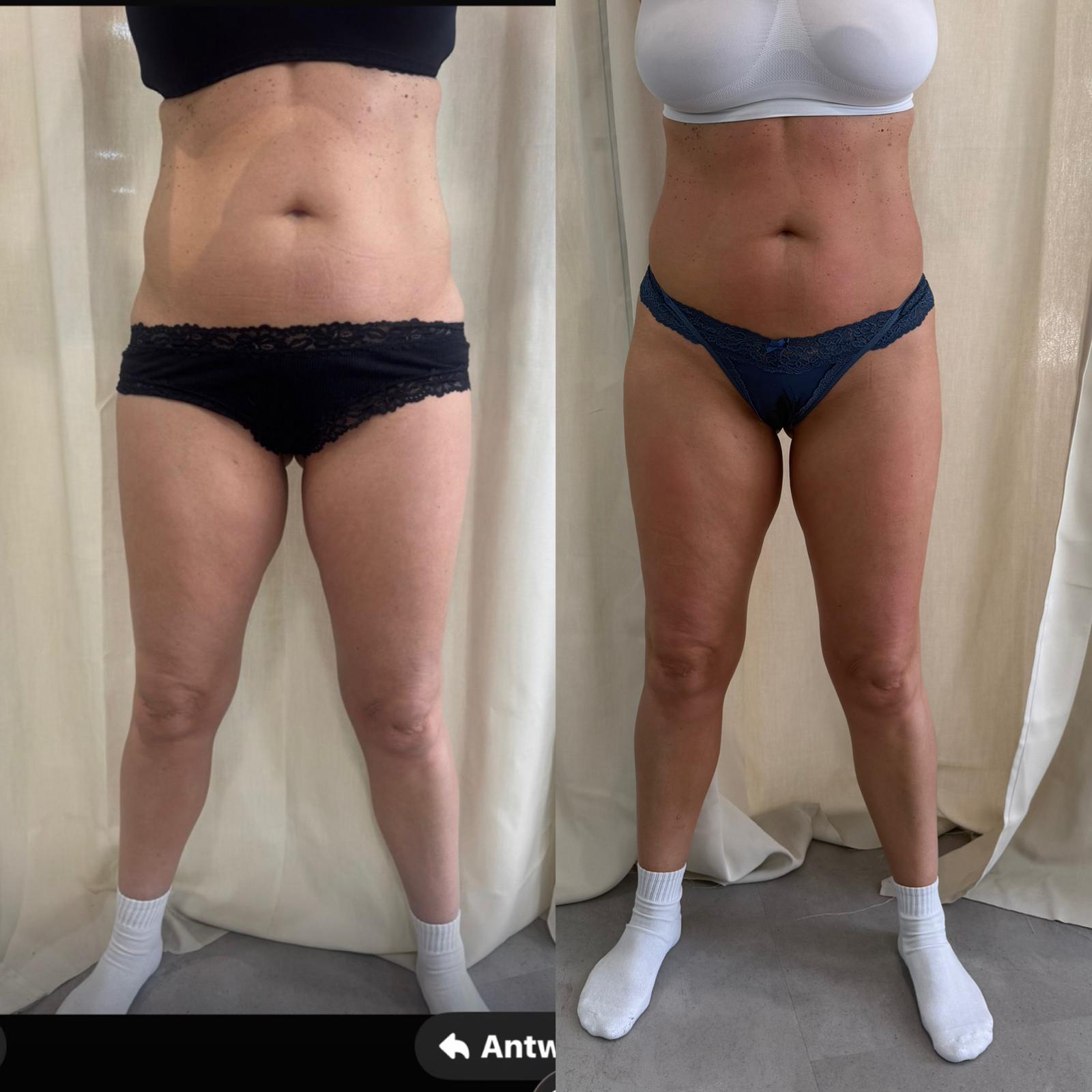 Bodyforming Vorher-Nachher-Eindruck bei Beauty Secrets in Wedel (Mehrere Behandlungen)