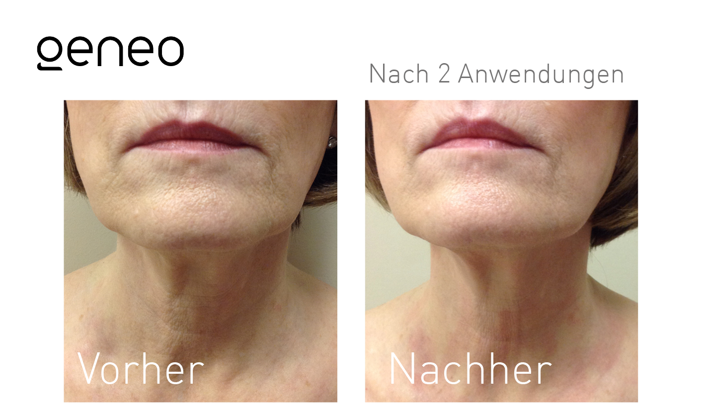 Geneo Vorher-Nachher-Ergebnis bei Beauty Secrets in Wedel – Nach 2 Behandlungen