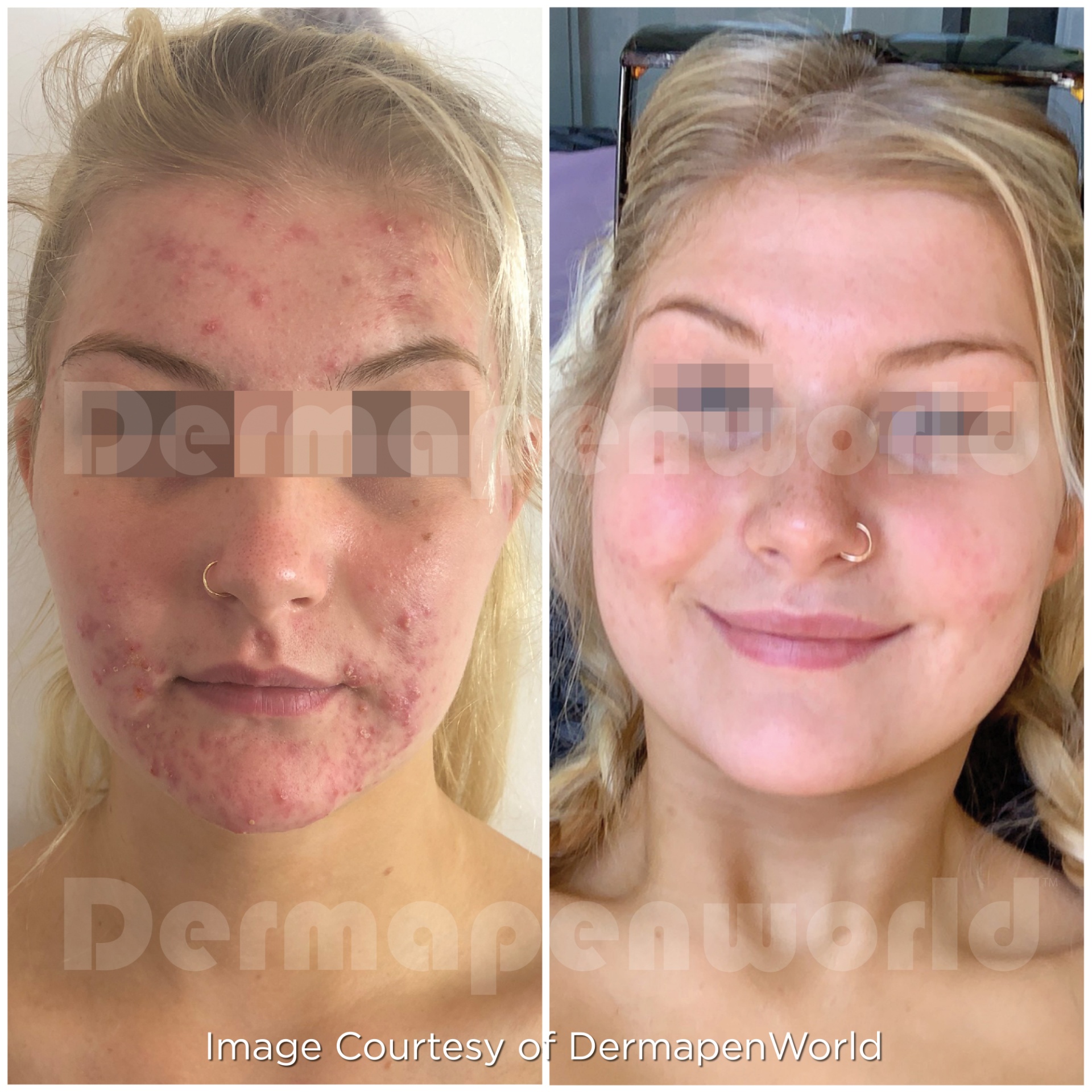Dermapen 4 Vorher-Nachher-Ergebnis bei Beauty Secrets in Wedel – Akne