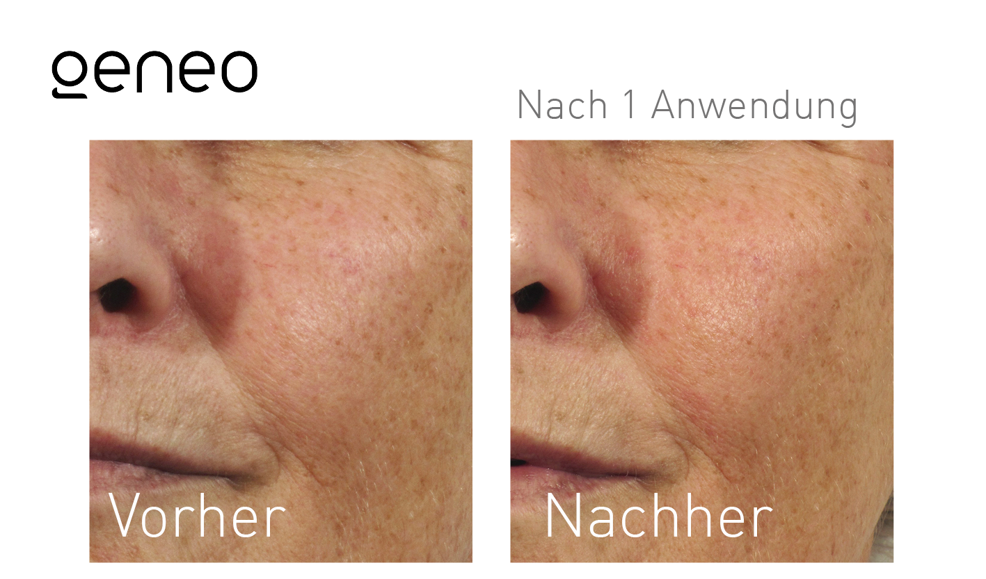 Geneo Vorher-Nachher-Ergebnis bei Beauty Secrets in Wedel – Nach 1 Behandlung