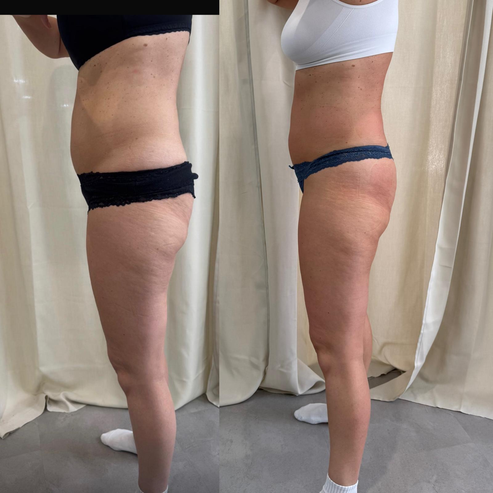 Bodyforming Vorher-Nachher-Eindruck bei Beauty Secrets in Wedel (Mehrere Behandlungen)