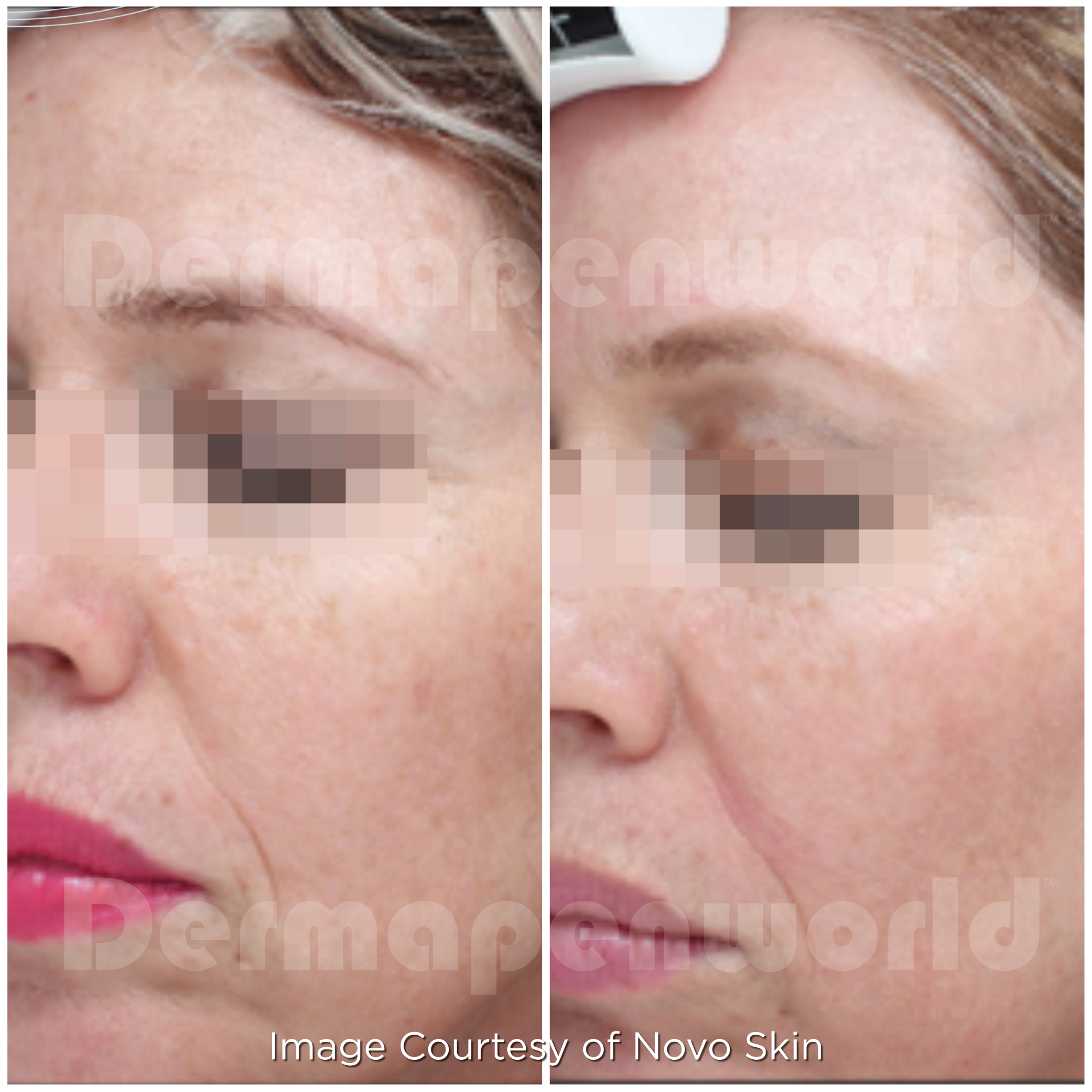 Dermapen 4 Vorher-Nachher-Ergebnis bei Beauty Secrets in Wedel – Pigmentflecken