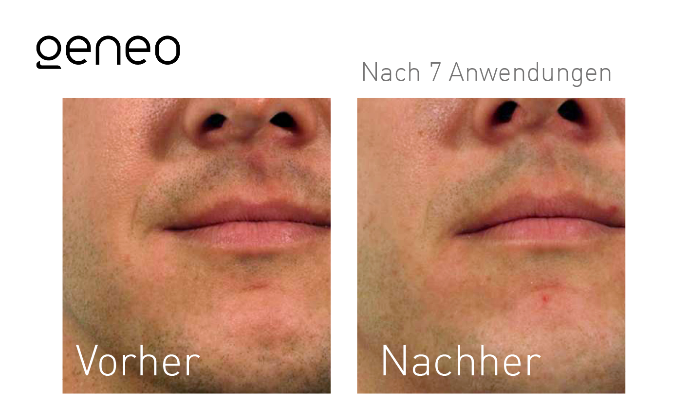 Geneo Vorher-Nachher-Ergebnis bei Beauty Secrets in Wedel – Nach 7 Behandlungen