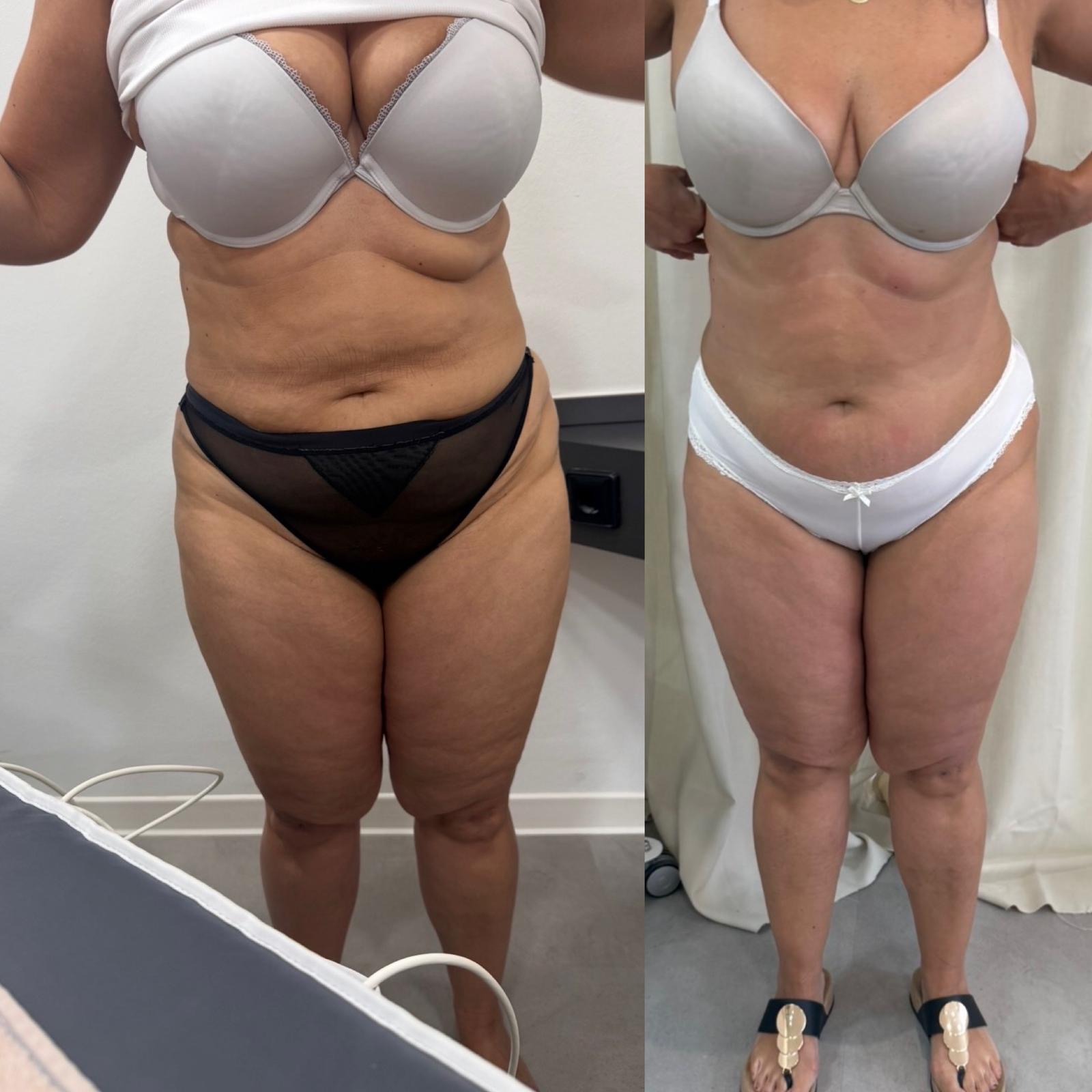 Bodyforming Vorher-Nachher-Eindruck bei Beauty Secrets in Wedel (Behandlungsverlauf nach 10 Anwendungen)