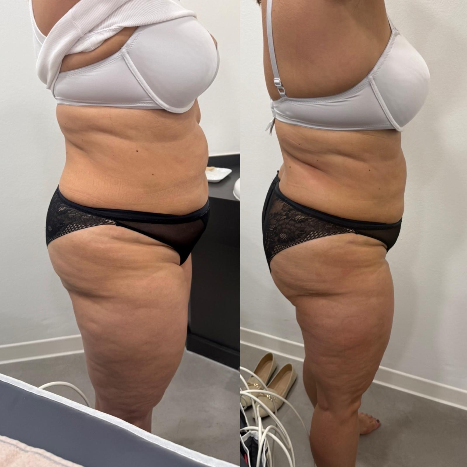 Bodyforming Vorher-Nachher-Eindruck bei Beauty Secrets in Wedel (Eine Behandlung)