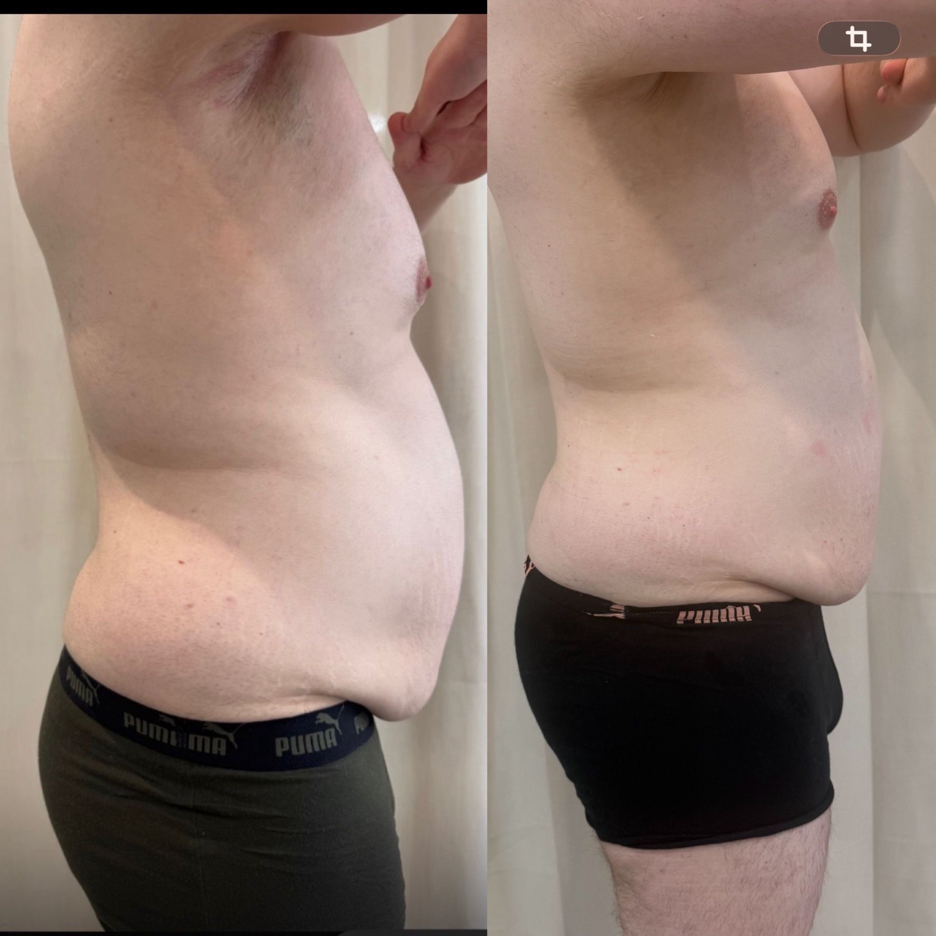 Bodyforming Vorher-Nachher-Eindruck bei Beauty Secrets in Wedel (Eine Behandlung)