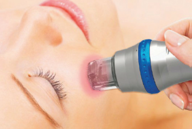 Ellisys RF Microneedling Behandlung bei Beauty Secrets in Wedel