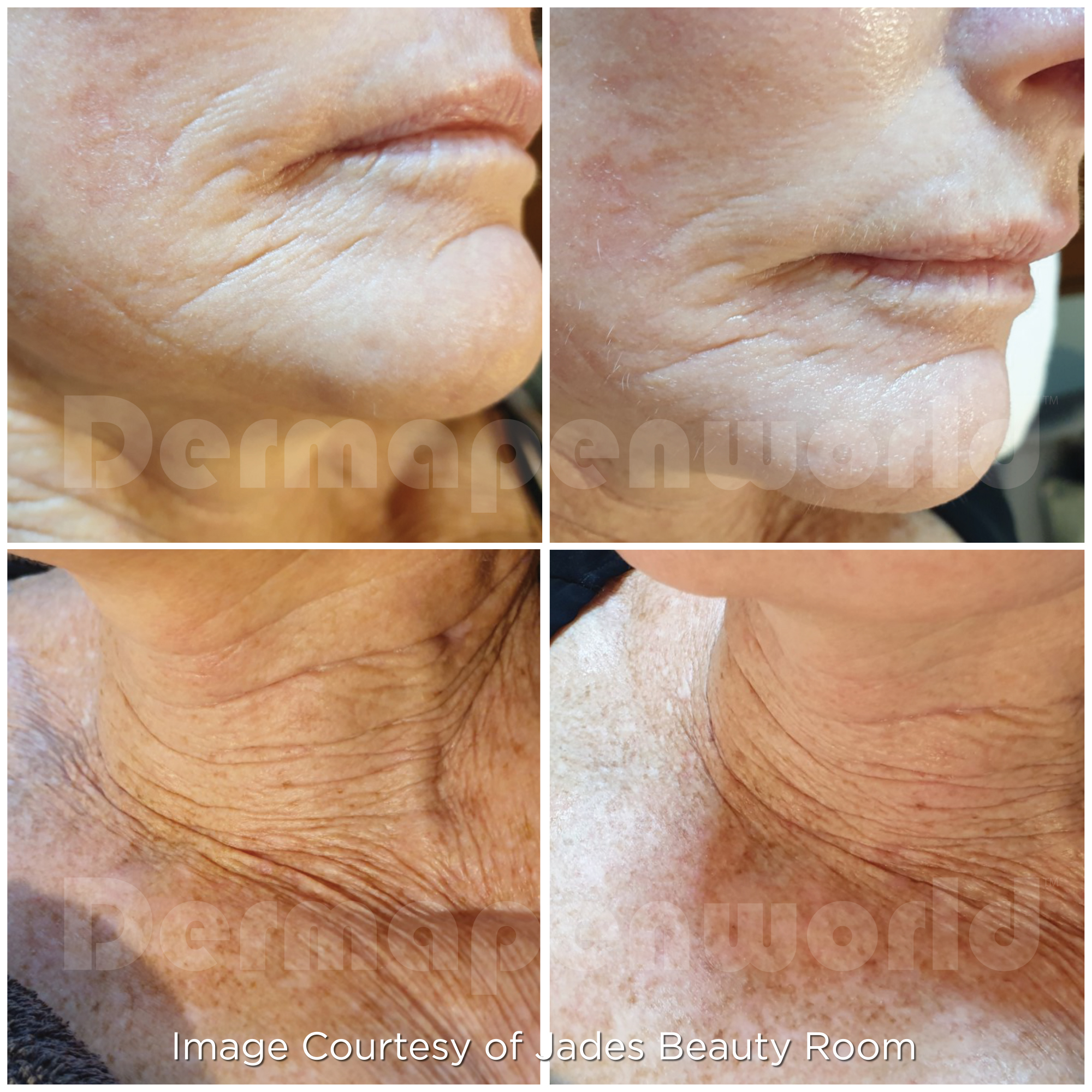 Dermapen 4 Vorher-Nachher-Ergebnis bei Beauty Secrets in Wedel – Fältchen & Hautalterung