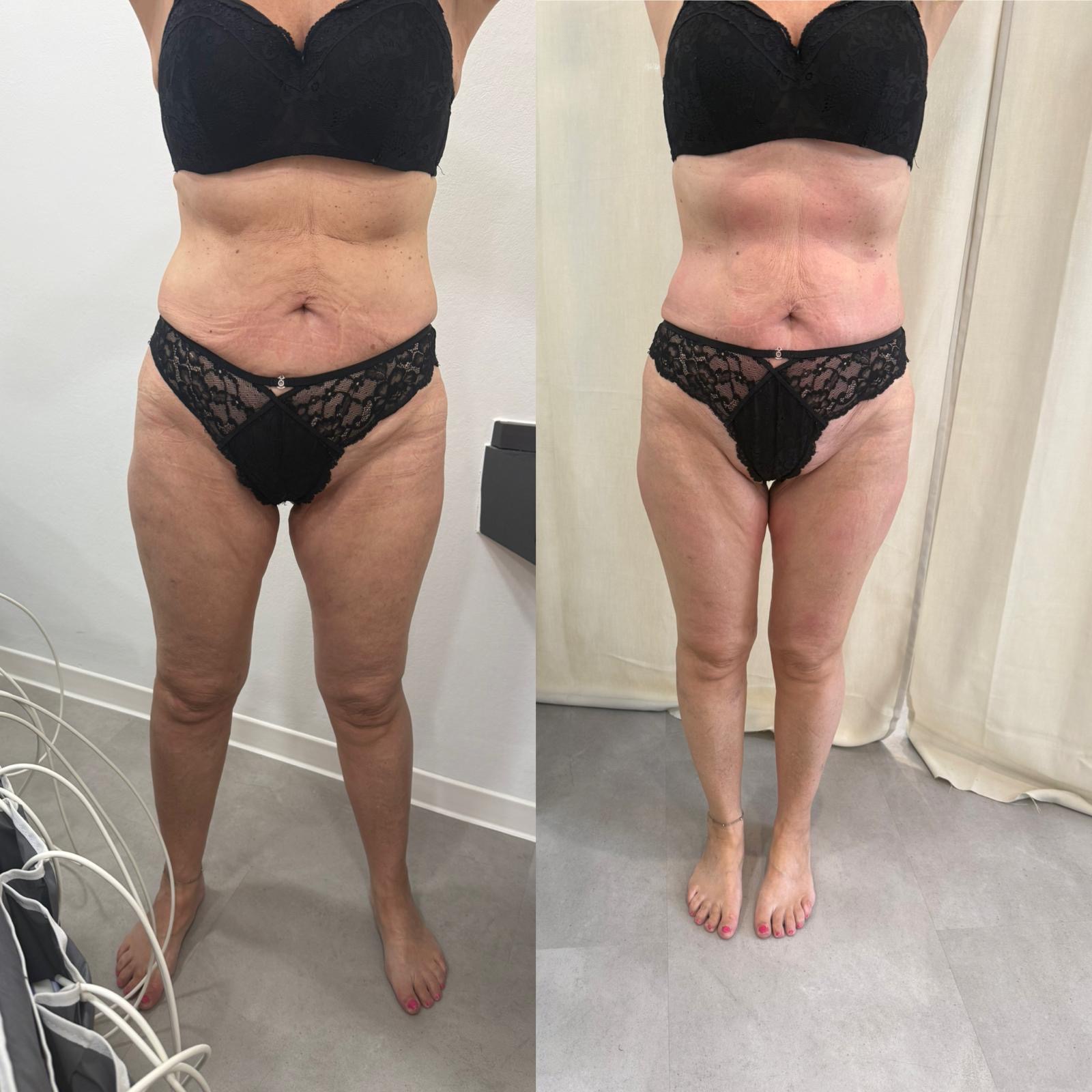 Bodyforming Vorher-Nachher-Eindruck bei Beauty Secrets in Wedel (Eine Behandlung)