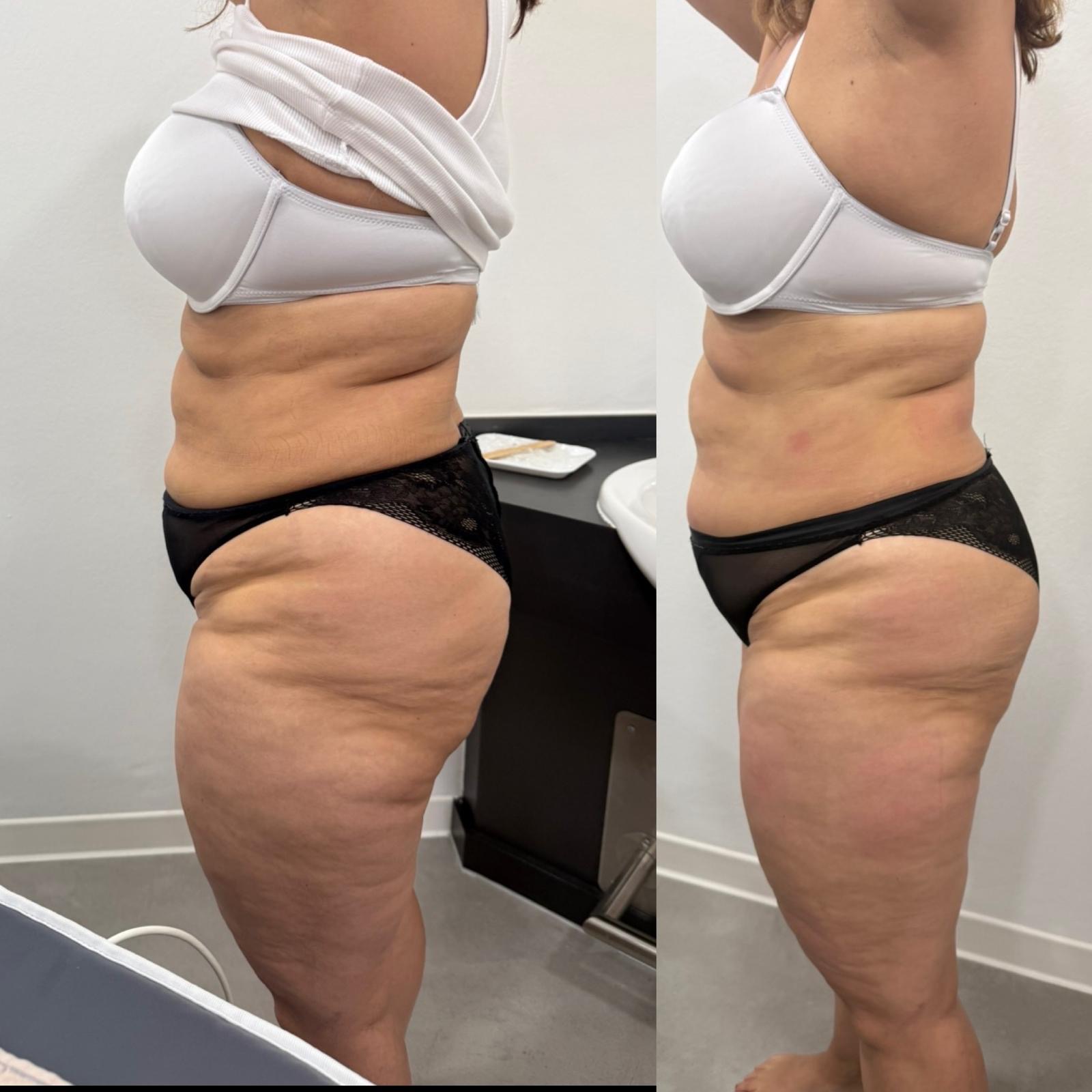Bodyforming Vorher-Nachher-Eindruck bei Beauty Secrets in Wedel (Eine Behandlung)