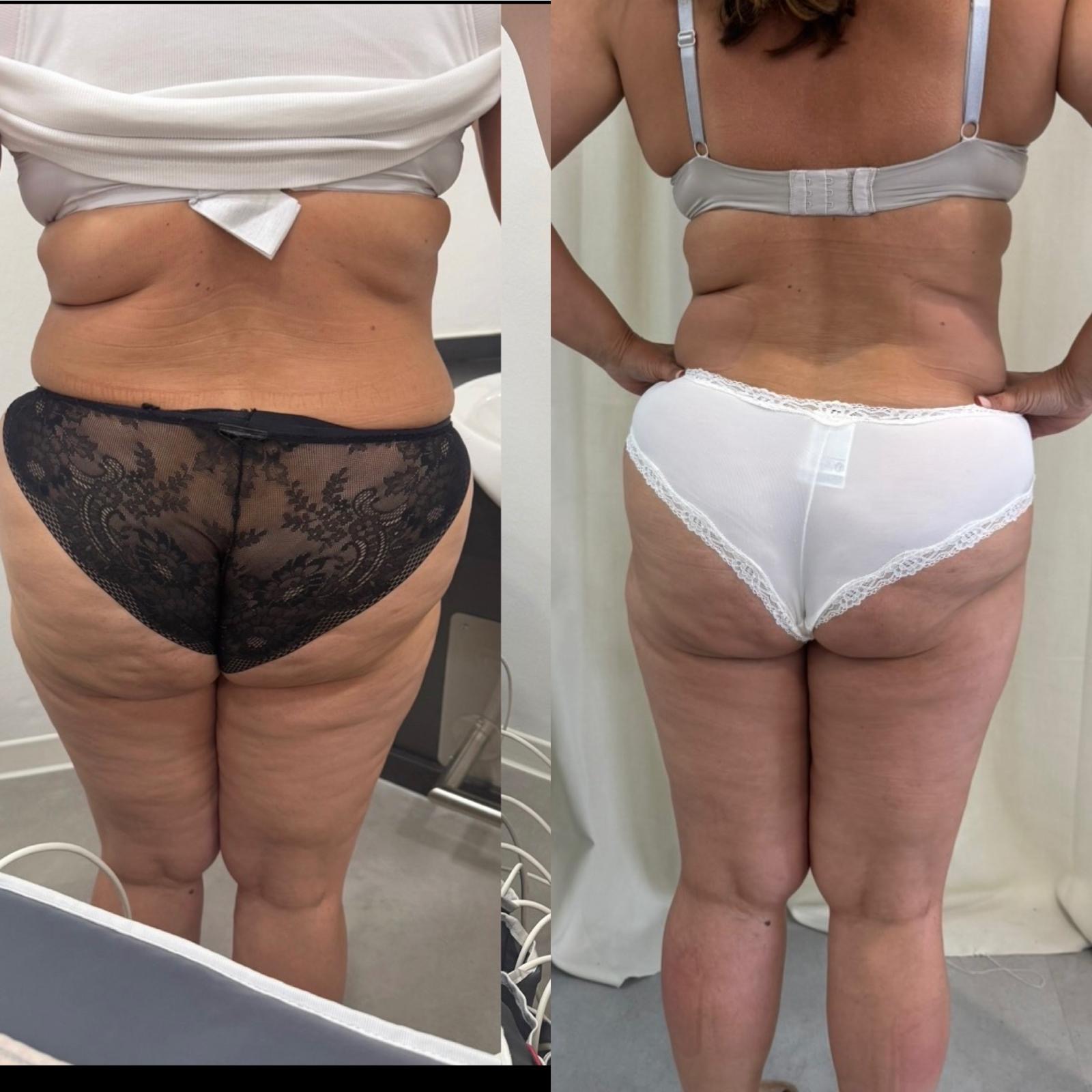 Bodyforming Vorher-Nachher-Eindruck bei Beauty Secrets in Wedel (Behandlungsverlauf nach 10 Anwendungen)