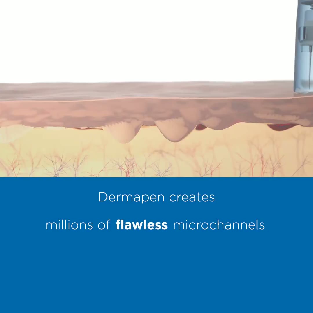 Dermapen 4 vs. Dermaroller