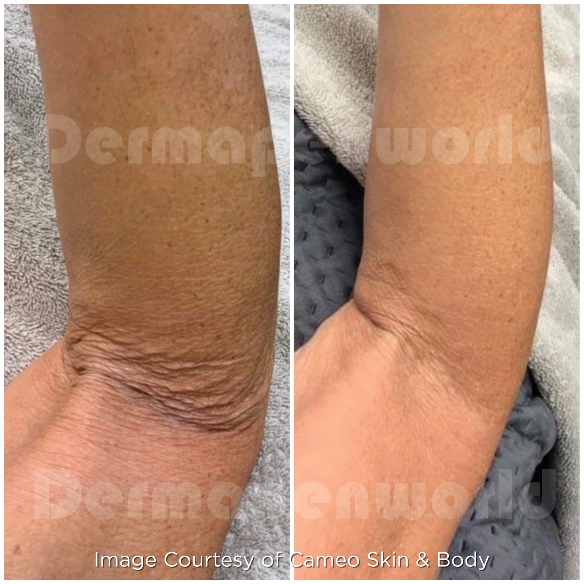 Dermapen 4 Vorher-Nachher-Ergebnis bei Beauty Secrets in Wedel – Hautverjüngung