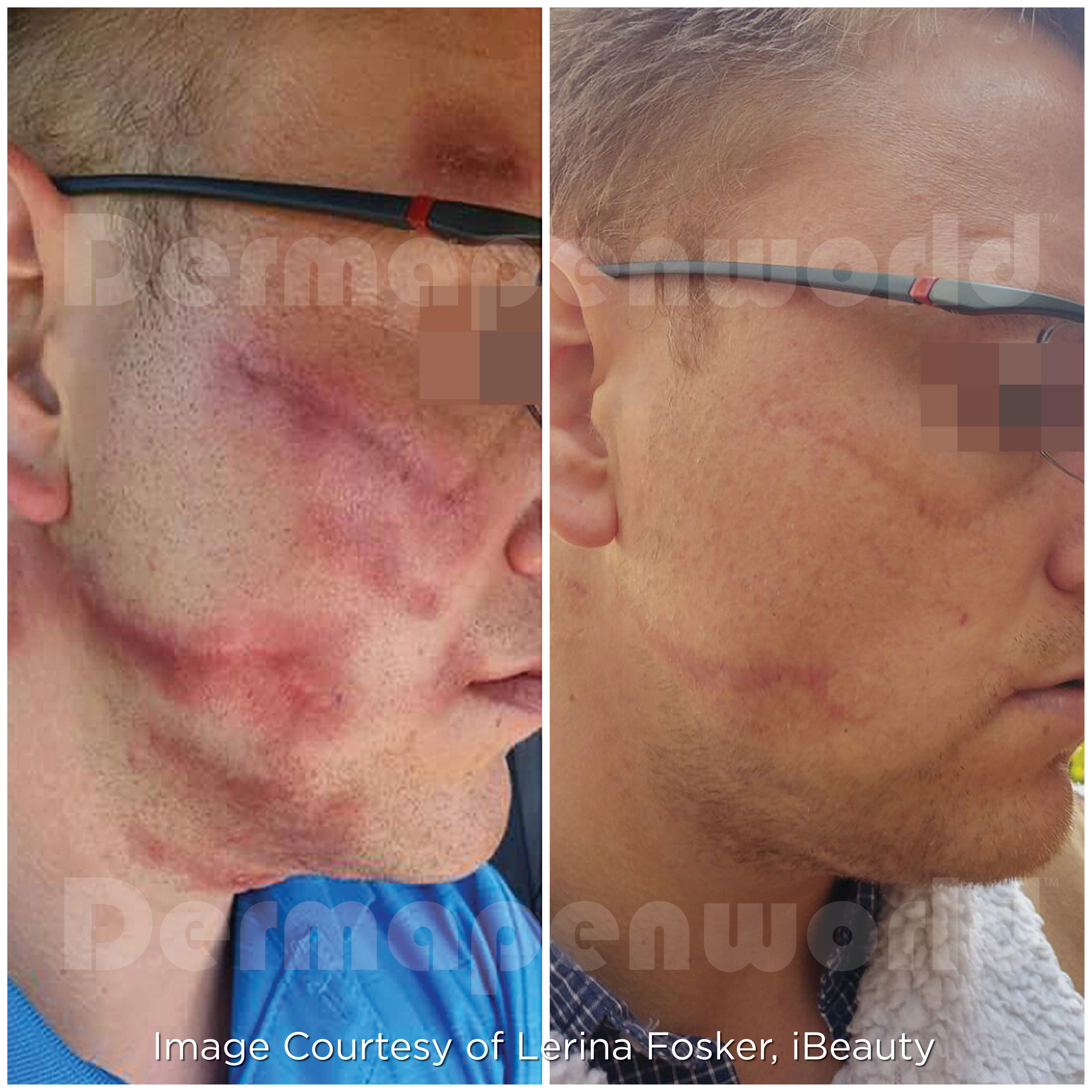 Dermapen 4 Vorher-Nachher-Ergebnis bei Beauty Secrets in Wedel – Operationsnarben