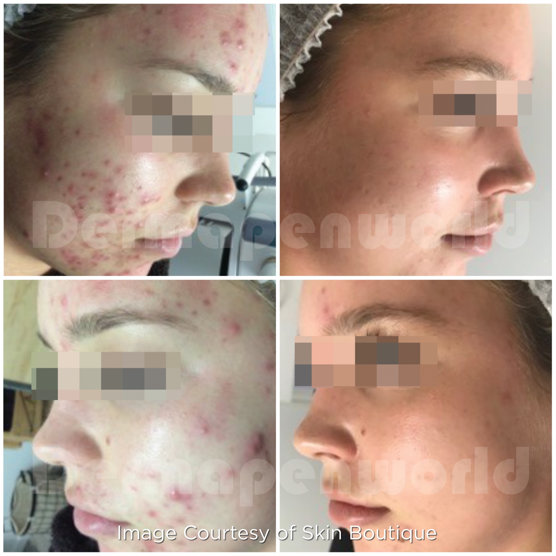 Dermapen 4 Vorher-Nachher-Ergebnis bei Beauty Secrets in Wedel – Akne