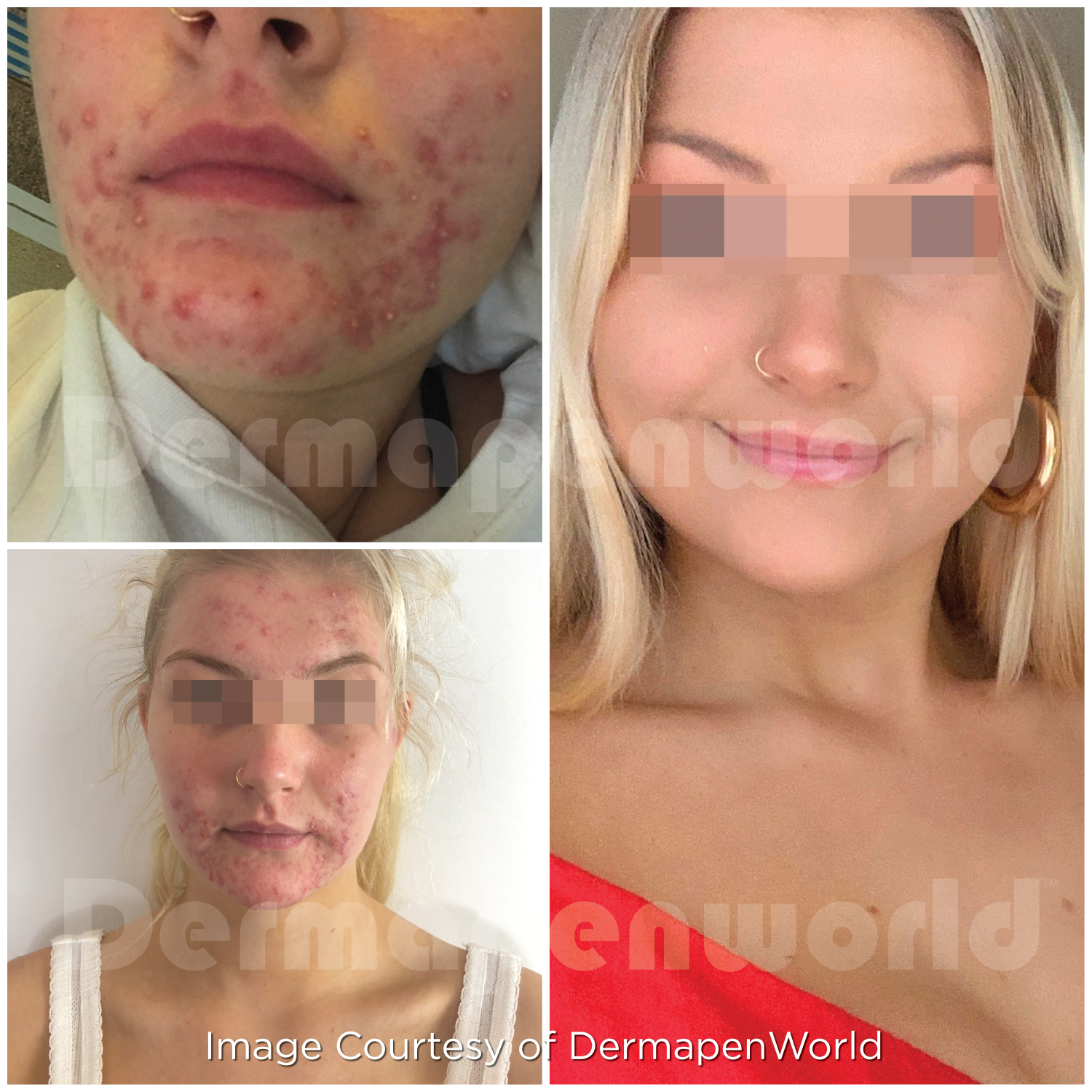 Dermapen 4 Vorher-Nachher-Ergebnis bei Beauty Secrets in Wedel – Akne