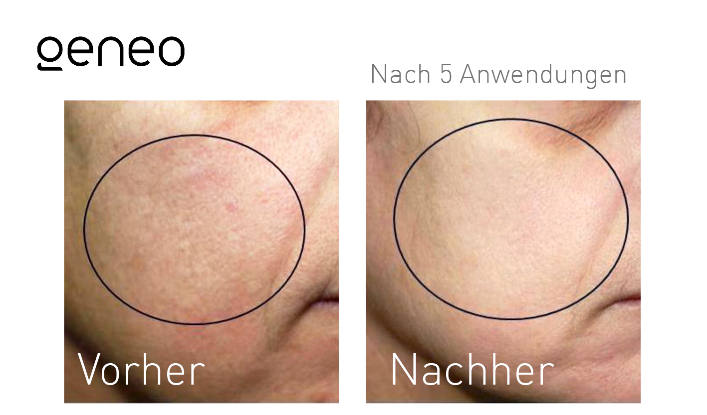 Geneo Vorher-Nachher-Ergebnis bei Beauty Secrets in Wedel – Nach 5 Behandlungen