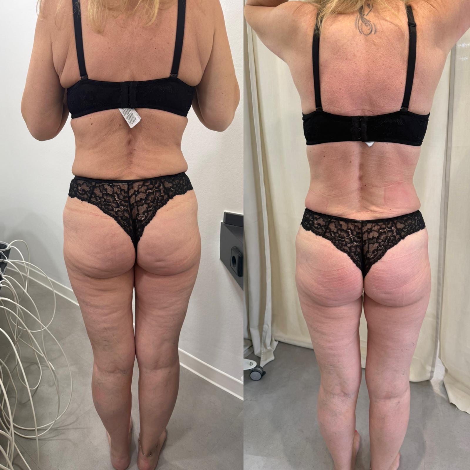 Bodyforming Vorher-Nachher-Eindruck bei Beauty Secrets in Wedel (Eine Behandlung)
