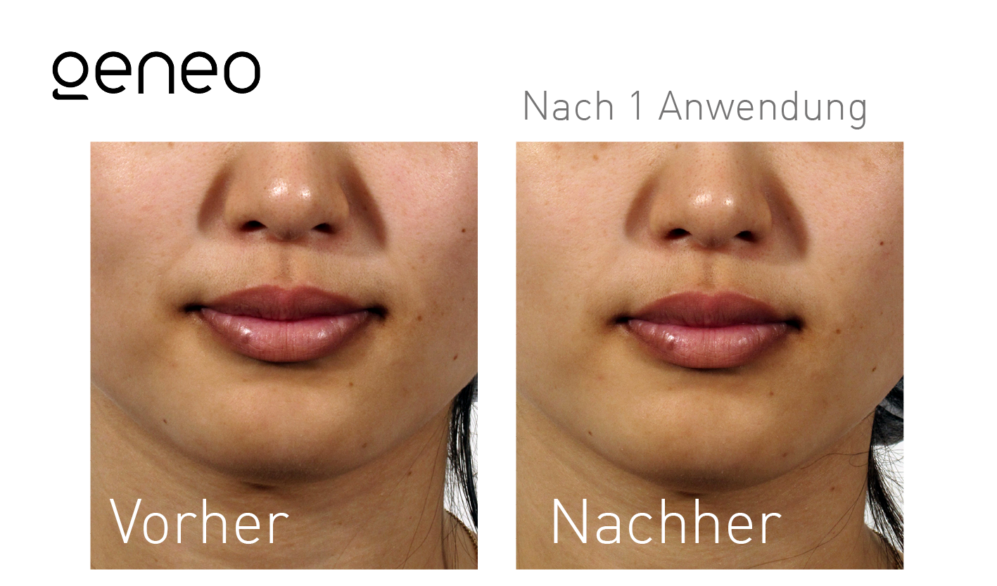 Geneo Vorher-Nachher-Ergebnis bei Beauty Secrets in Wedel – Nach 1 Behandlung