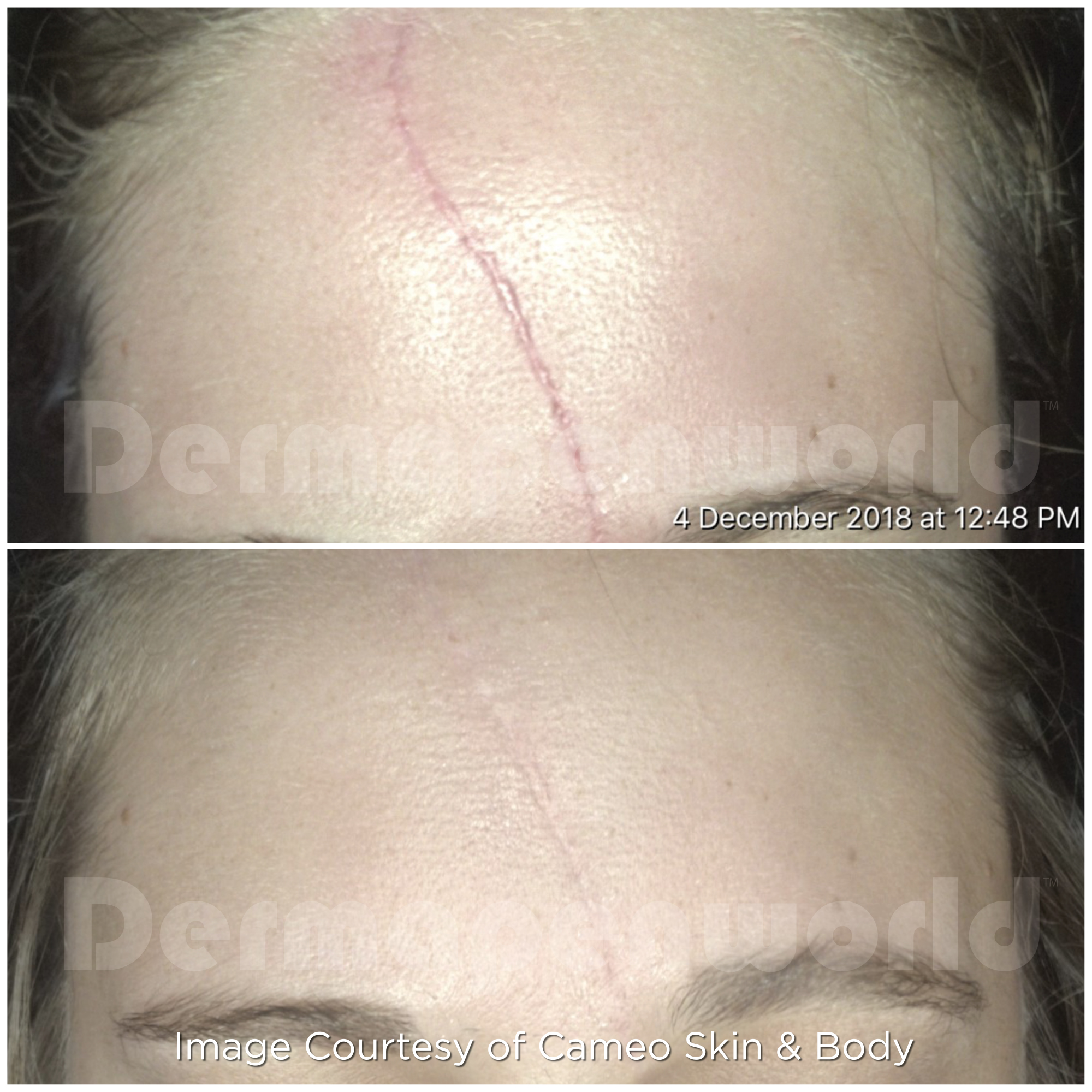 Dermapen 4 Vorher-Nachher-Ergebnis bei Beauty Secrets in Wedel – Narben