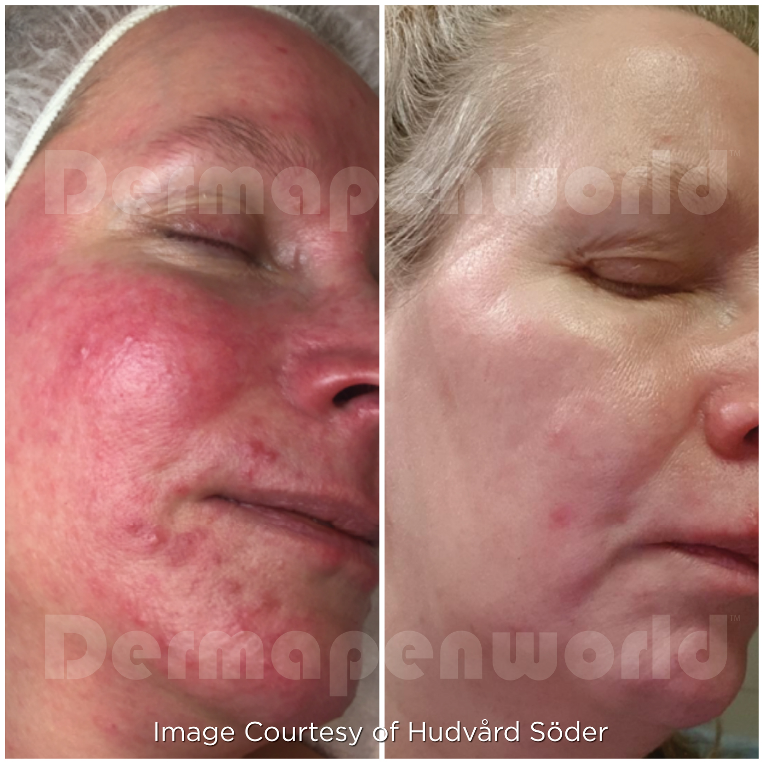 Dermapen 4 Vorher-Nachher-Ergebnis bei Beauty Secrets in Wedel – Rosacea