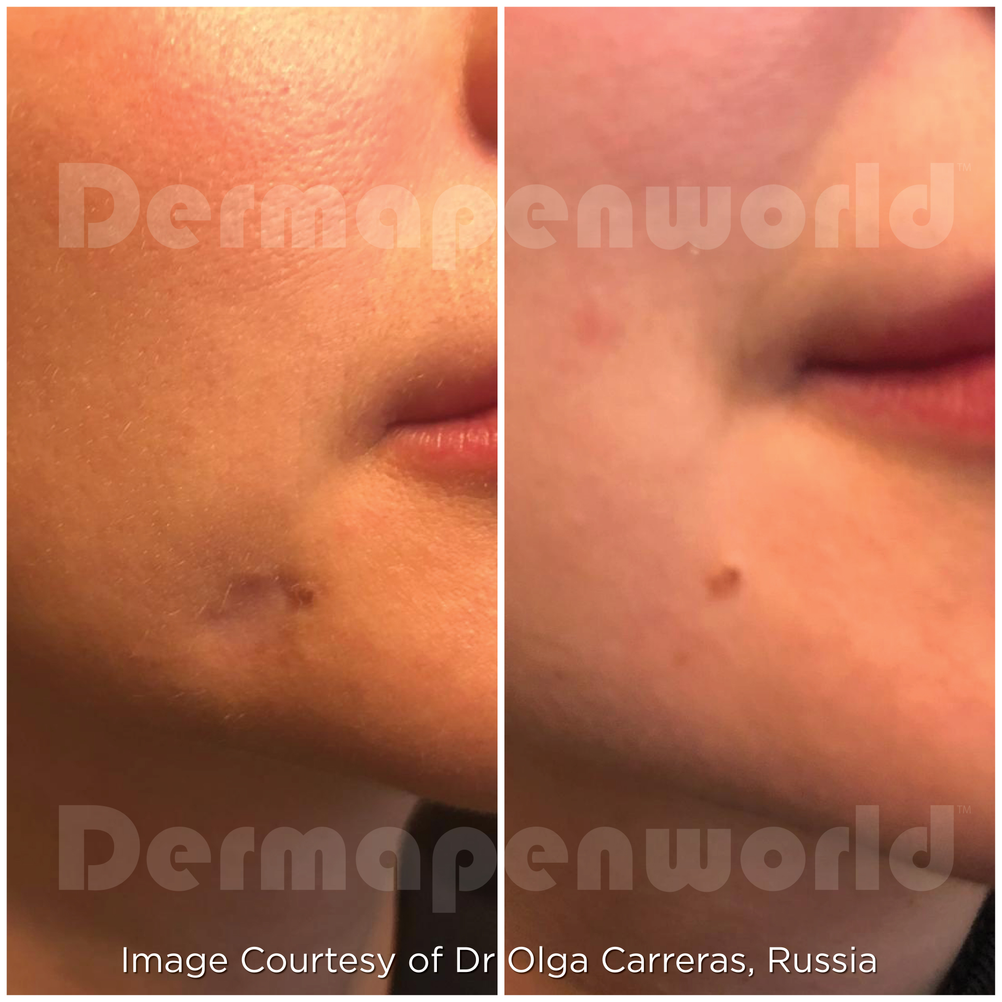 Dermapen 4 Vorher-Nachher-Ergebnis bei Beauty Secrets in Wedel – Verletzungsnarben