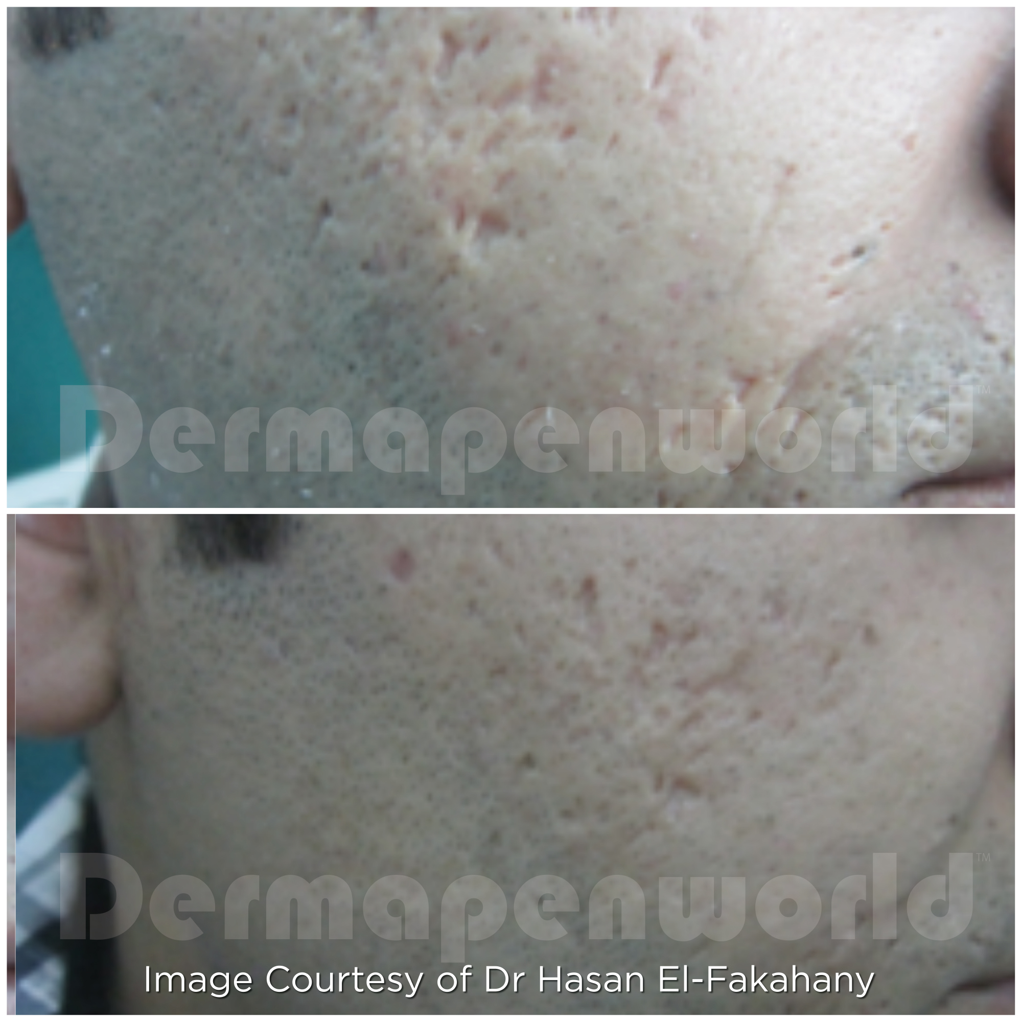 Dermapen 4 Vorher-Nachher-Ergebnis bei Beauty Secrets in Wedel – Aknenarben